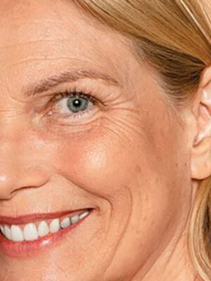 Radiesse - Estimulador De Colágeno